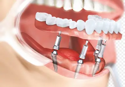 Implanturi dentare vs. proteze tradiționale