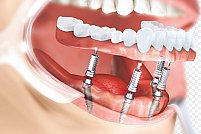 Implanturi dentare vs. proteze tradiționale